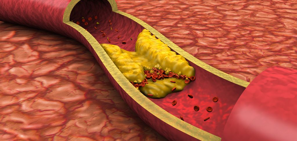 Wysoki cholesterol